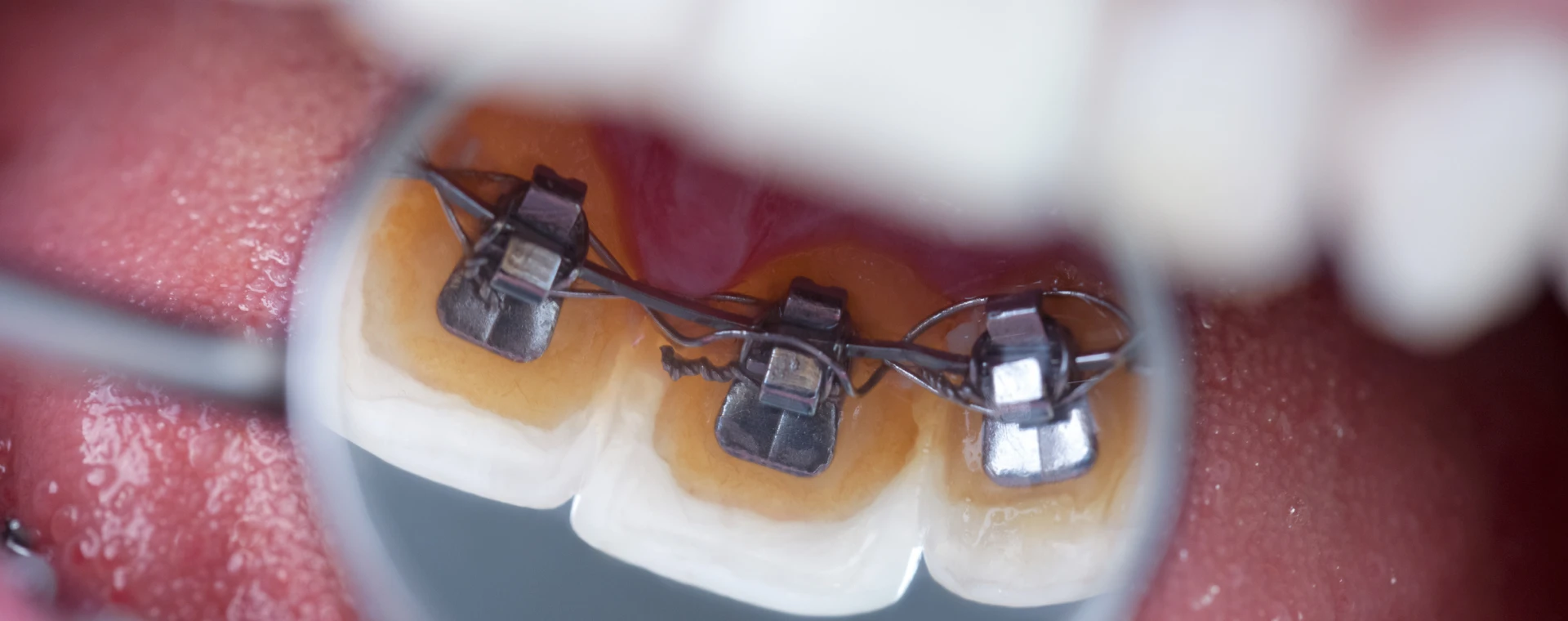 Appareils multi-attaches linguaux, orthodontie linguale au Cabinet d'Orthodontie du Dr Jérémy Ohayon