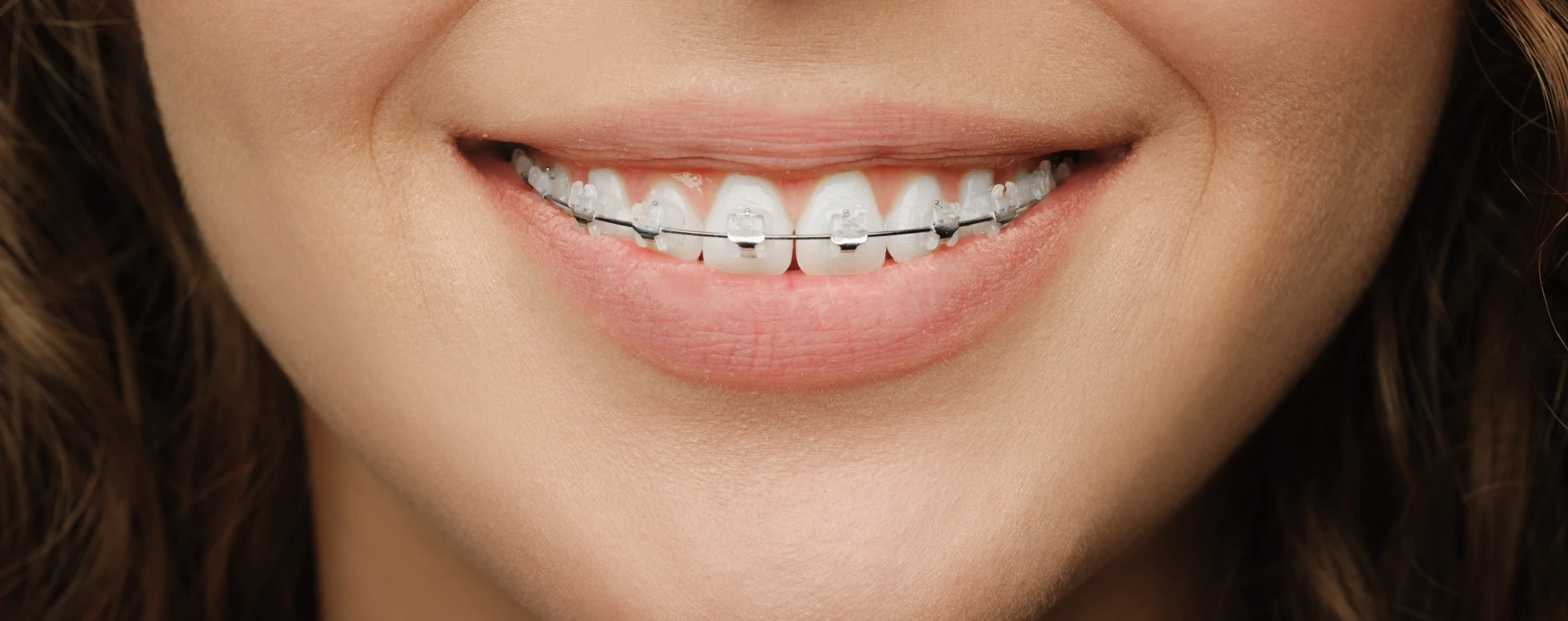 Orthodontie de l'adolescent au cabinet d'Orthodontie du Docteur Jérémy Ohayon