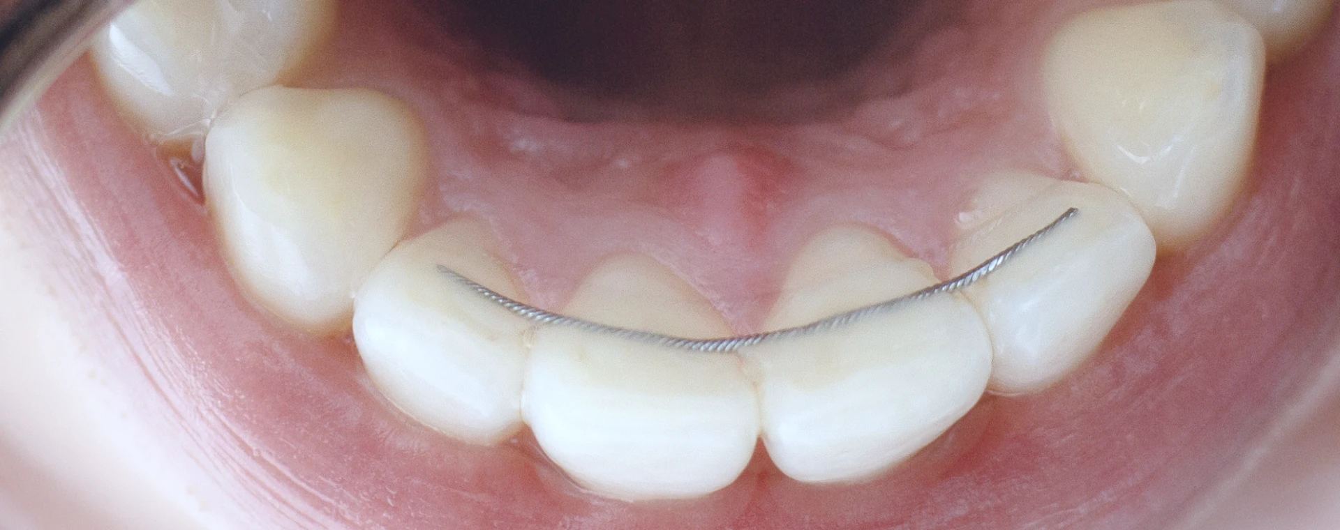 Appareils de contention amovibles ou fixés au cabinet d'Orthodontie du Dr OHAYON