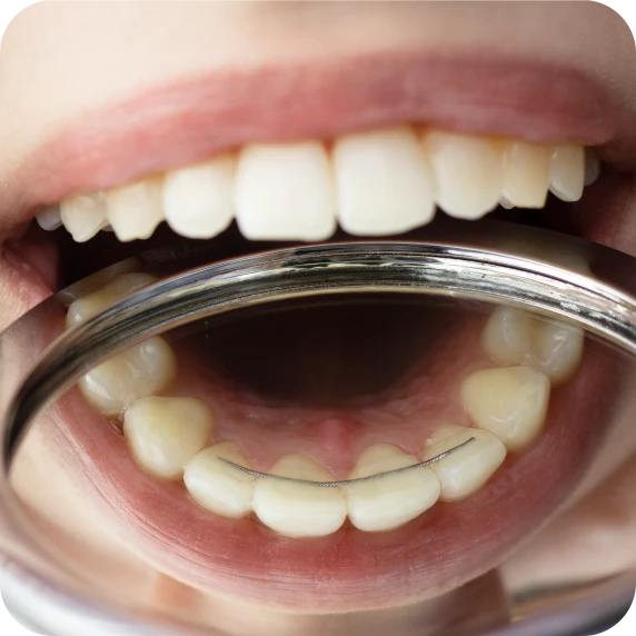 La contention, à quoi sert-elle? - Maintenir les dents dans leur nouvelle position