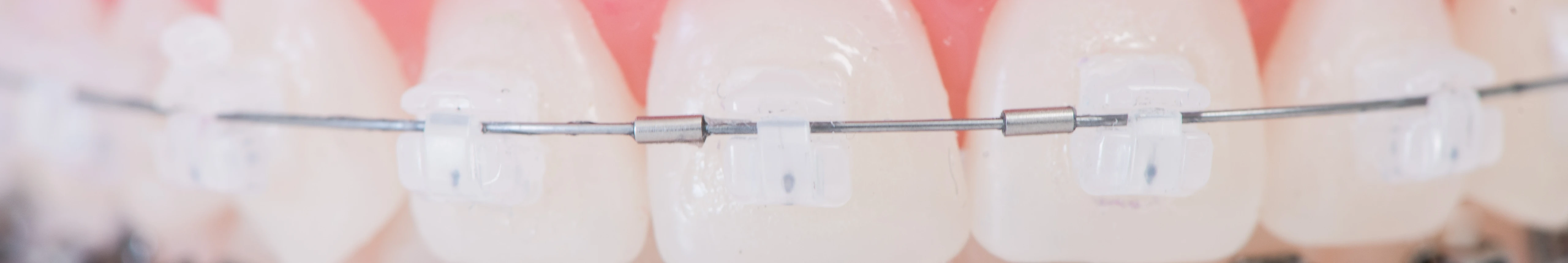 Orthodontie de l'adolescent : appareils de contention, appareils orthodontiques, gouttières transparentes