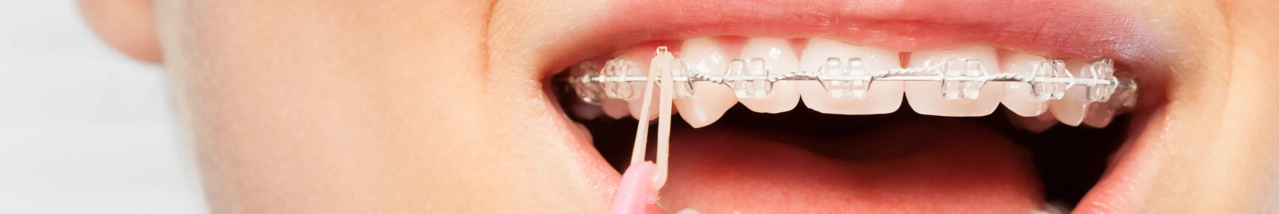 Les élastiques d'orthodontie : des bagues ou des gouttières transparentes au cabinet du Docteur Jérémy Ohayon