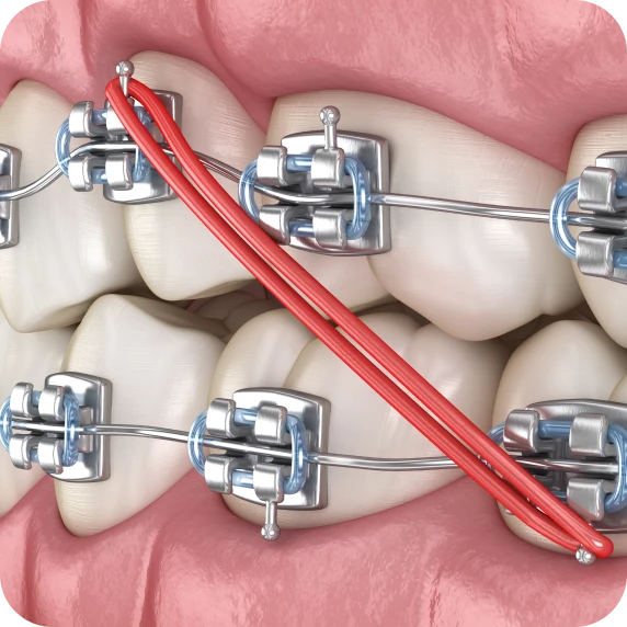 Les élastiques : à quoi ça sert? Сonseils du Dr Ohayon : utilisation, avantages et précautions