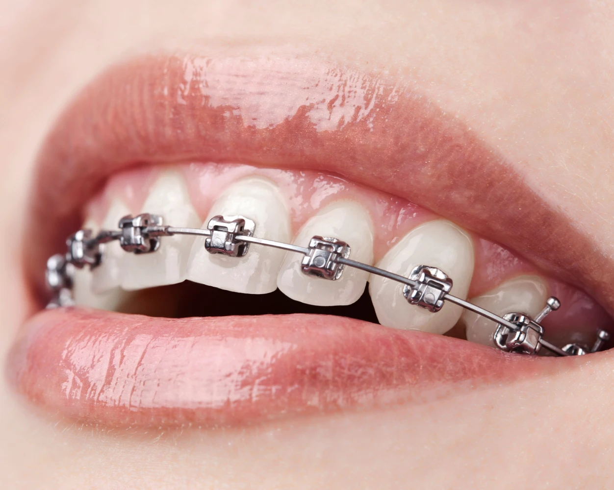 Incidents en orthodontie au cabinet d'orthodontie du Dr Ohayon