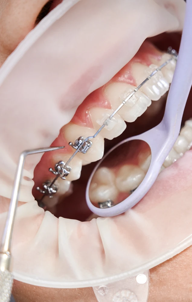 Incidents dentaires et solutions au cabinet d'orthodontie du Dr Ohayon