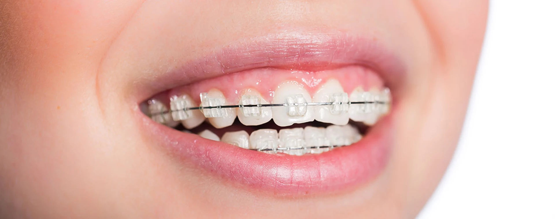 Appareils multi-attaches, appareils multi-attaches linguaux au cabinet d'Orthodontie du Docteur Jérémy Ohayon