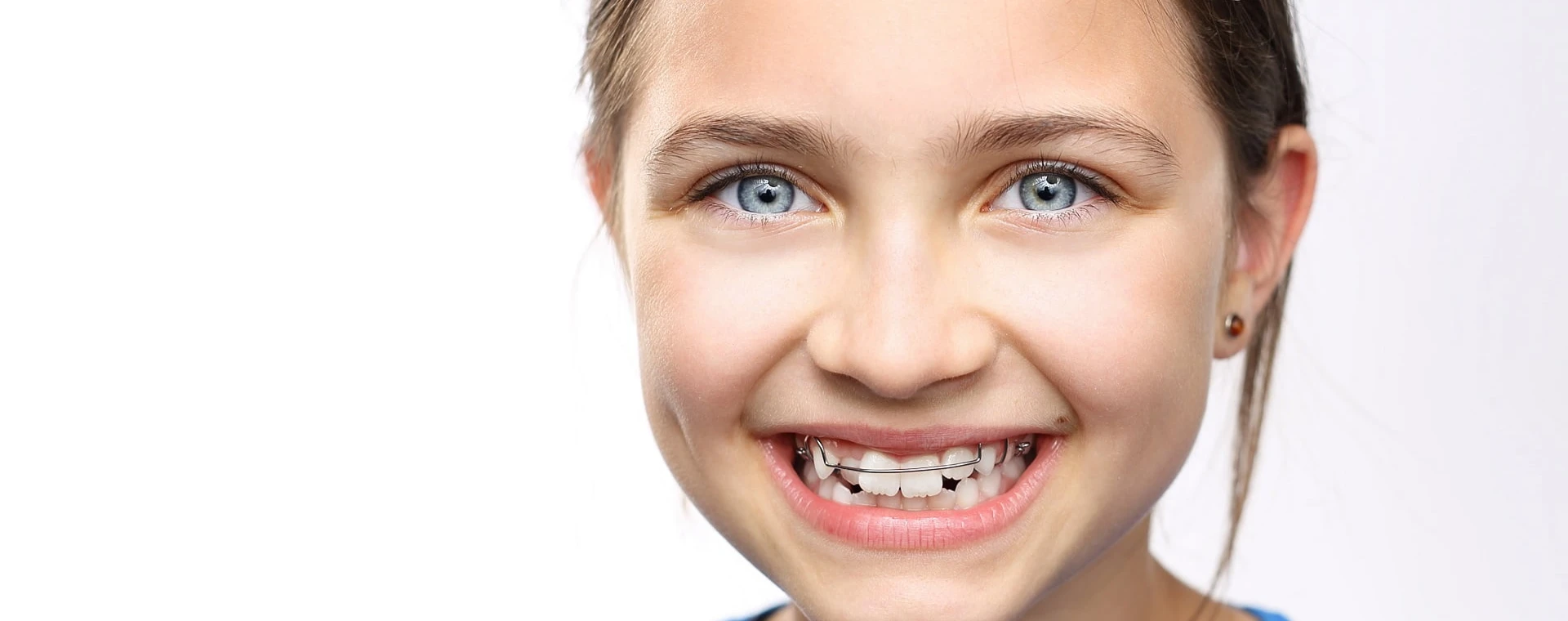 Traitements orthodontiques pour les enfants au Cabinet d'Orthodontie du Dr Jérémy Ohayon