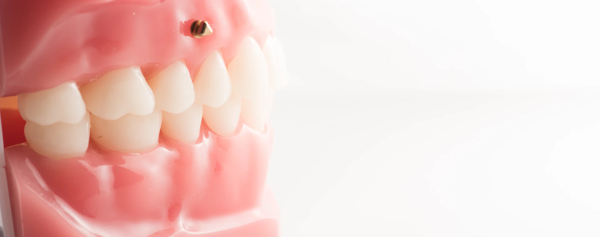 Cabinet du Dr Ohayon : ancrages osseux en cas de capital dentaire et osseux réduit