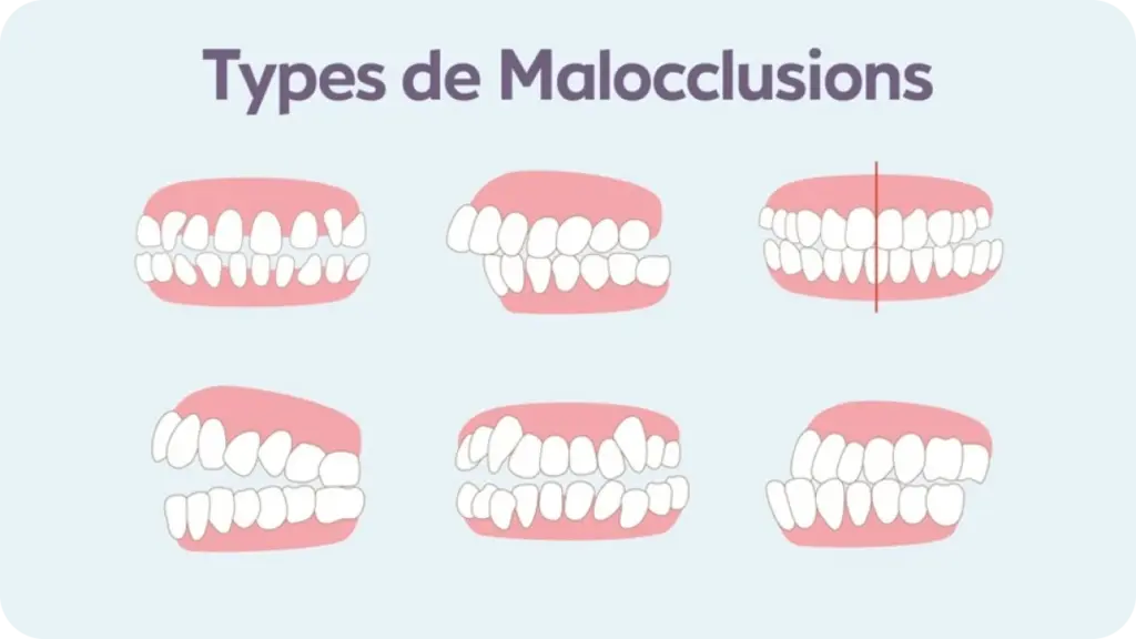 Malocclusions dentaires