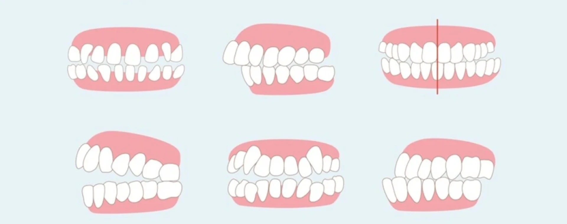 Dr Ohayon : malocclusions dentaires comme une anomalie de l’occlusion