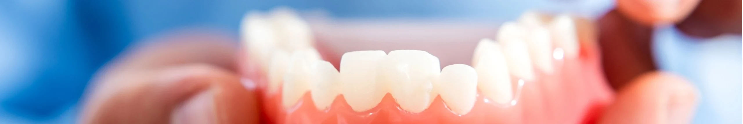 Malocclusions dentaires au Cabinet d'Orthodontie du Dr OHAYON