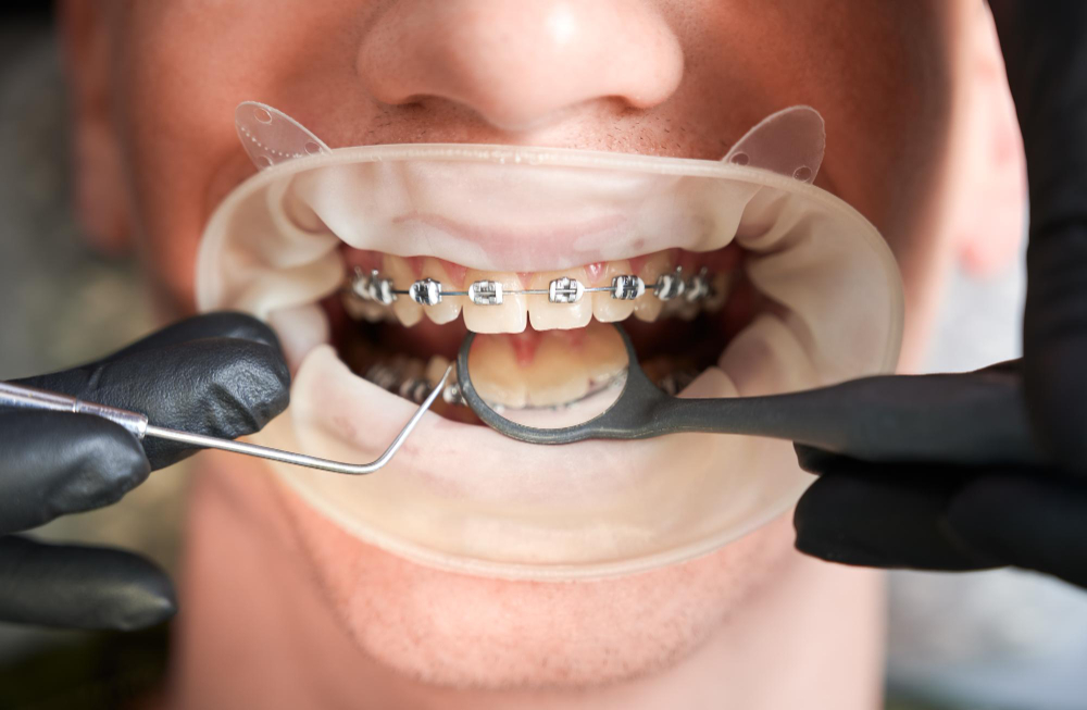 Orthodontie adulte