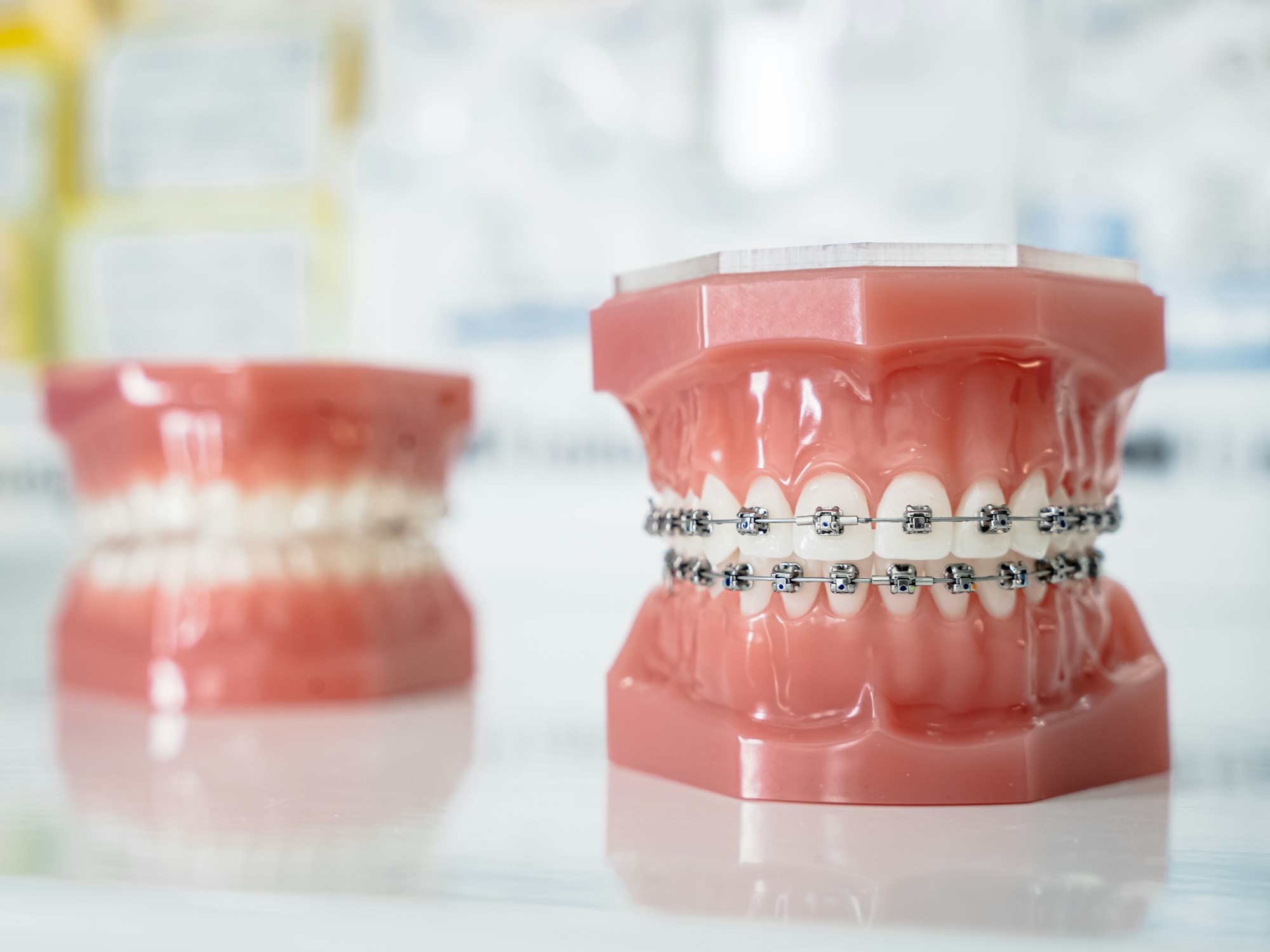 modèles dentaires comparant un appareil avec bagues et une dentition sans bagues