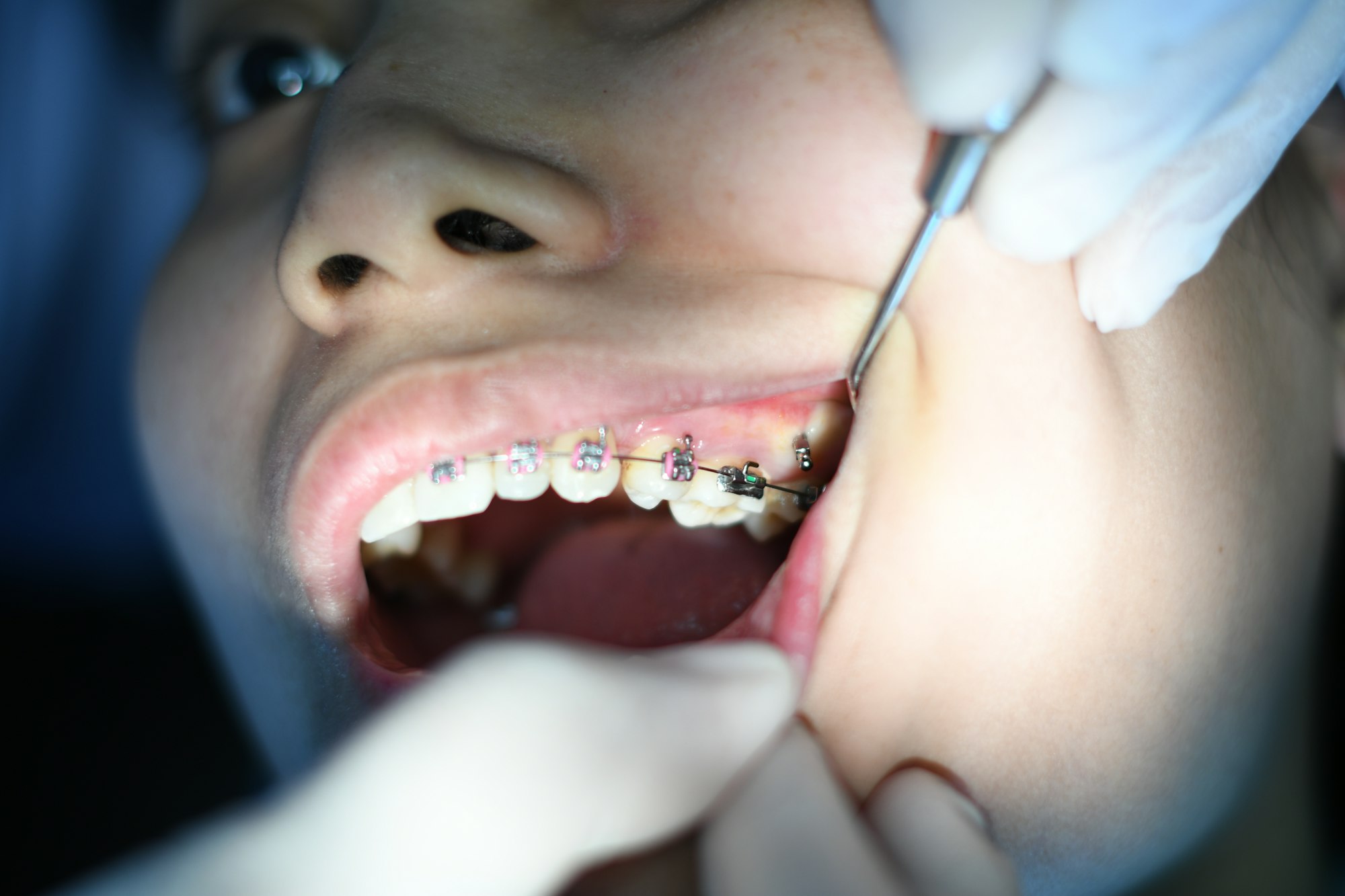 orthodontiste resserrant un appareil dentaire avec un instrument
