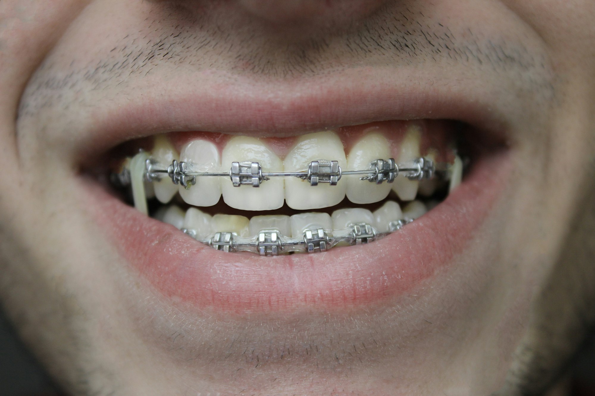 img7_smilebraces