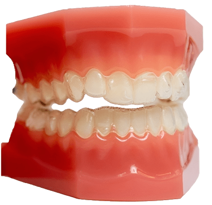 Gouttières transparentes Invisalign - Dr Ohayon Strasbourg